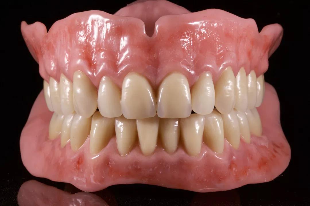 吸附性全口义齿